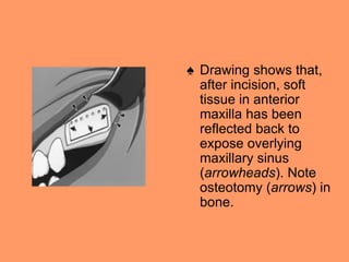 ♠ Drawing shows that,
after incision, soft
tissue in anterior
maxilla has been
reflected back to
expose overlying
maxillary sinus
(arrowheads). Note
osteotomy (arrows) in
bone.
 