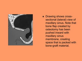 ♠ Drawing shows cross-
sectional (lateral) view of
maxillary sinus. Note that
bone flap created by
osteotomy has been
pushed inward with
maxillary sinus
membrane, creating
space that is packed with
bone-graft material.
 