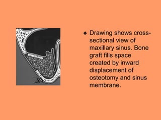 ♠ Drawing shows cross-
sectional view of
maxillary sinus. Bone
graft fills space
created by inward
displacement of
osteotomy and sinus
membrane.
 