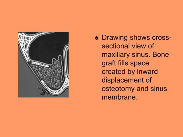 MAXILLARY SINUS LIFT PROCEDURES.ppt