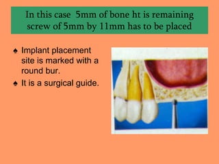 In this case 5mm of bone ht is remaining
screw of 5mm by 11mm has to be placed
♠ Implant placement
site is marked with a
round bur.
♠ It is a surgical guide.
 