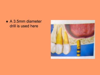 ♠ A 3.5mm diameter
drill is used here
 