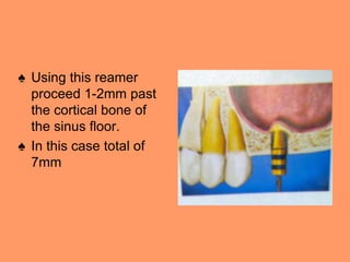 ♠ Using this reamer
proceed 1-2mm past
the cortical bone of
the sinus floor.
♠ In this case total of
7mm
 