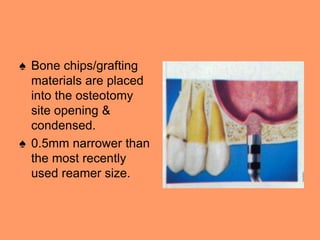 ♠ Bone chips/grafting
materials are placed
into the osteotomy
site opening &
condensed.
♠ 0.5mm narrower than
the most recently
used reamer size.
 