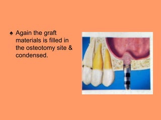 ♠ Again the graft
materials is filled in
the osteotomy site &
condensed.
 