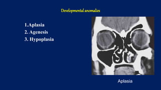 Developmental anomalies
1.Aplasia
2. Agenesis
3. Hypoplasia
Aplasia
 