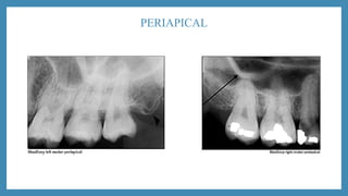 PERIAPICAL
 
