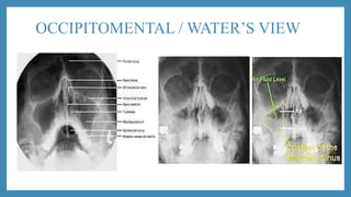OCCIPITOMENTAL / WATER’S VIEW
 