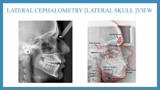 LATERAL CEPHALOMETRY [LATERAL SKULL ]VIEW
 