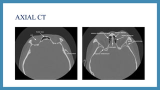 AXIAL CT
 