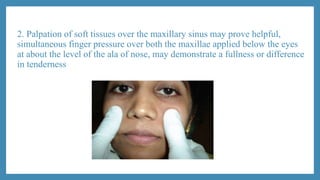 2. Palpation of soft tissues over the maxillary sinus may prove helpful,
simultaneous finger pressure over both the maxillae applied below the eyes
at about the level of the ala of nose, may demonstrate a fullness or difference
in tenderness
 