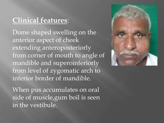 Clinical features:
Dome shaped swelling on the
anterior aspect of cheek
extending anteroposteriorly
from corner of mouth to angle of
mandible and superoinferiorly
from level of zygomatic arch to
inferior border of mandible.
When pus accumulates on oral
side of muscle,gum boil is seen
in the vestibule.
 