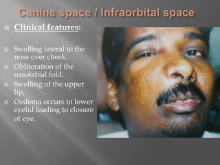  Clinical features:
 Swelling lateral to the
nose over cheek.
 Obliteration of the
nasolabial fold,
 Swelling of the upper
lip,
 Oedema occurs in lower
eyelid leading to closure
of eye.
 
