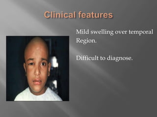 Mild swelling over temporal
Region.
Difficult to diagnose.
 