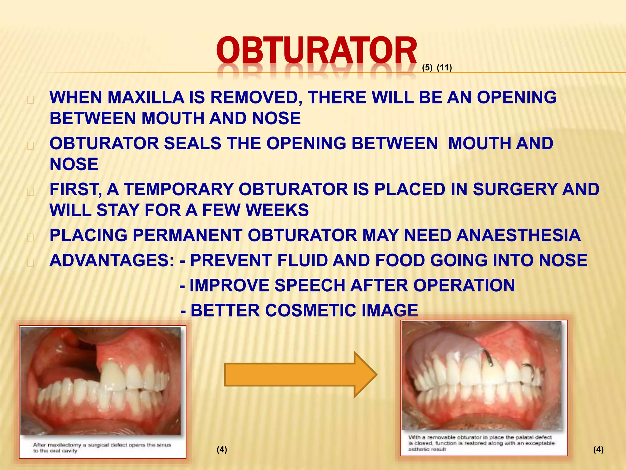 OBTURATOR
WHEN MAXILLA IS REMOVED, THERE WILL BE AN OPENING
BETWEEN MOUTH AND NOSE
OBTURATOR SEALS THE OPENING BETWEEN MOUTH AND
NOSE
FIRST, A TEMPORARY OBTURATOR IS PLACED IN SURGERY AND
WILL STAY FOR A FEW WEEKS
PLACING PERMANENT OBTURATOR MAY NEED ANAESTHESIA
ADVANTAGES: - PREVENT FLUID AND FOOD GOING INTO NOSE
- IMPROVE SPEECH AFTER OPERATION
- BETTER COSMETIC IMAGE
(4) (4)
(5) (11)
 