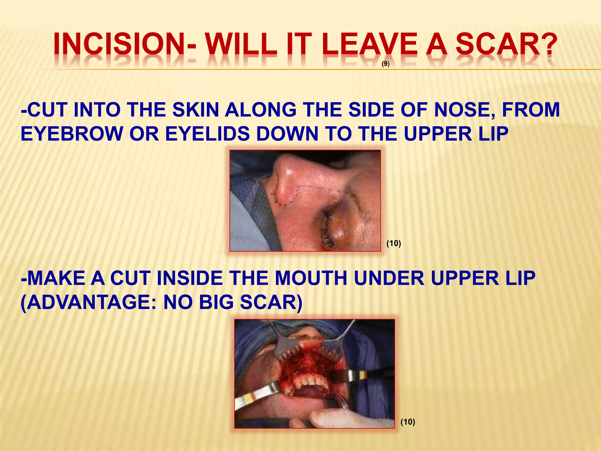 INCISION- WILL IT LEAVE A SCAR?
-CUT INTO THE SKIN ALONG THE SIDE OF NOSE, FROM
EYEBROW OR EYELIDS DOWN TO THE UPPER LIP
-MAKE A CUT INSIDE THE MOUTH UNDER UPPER LIP
(ADVANTAGE: NO BIG SCAR)
(9)
(10)
(10)
 