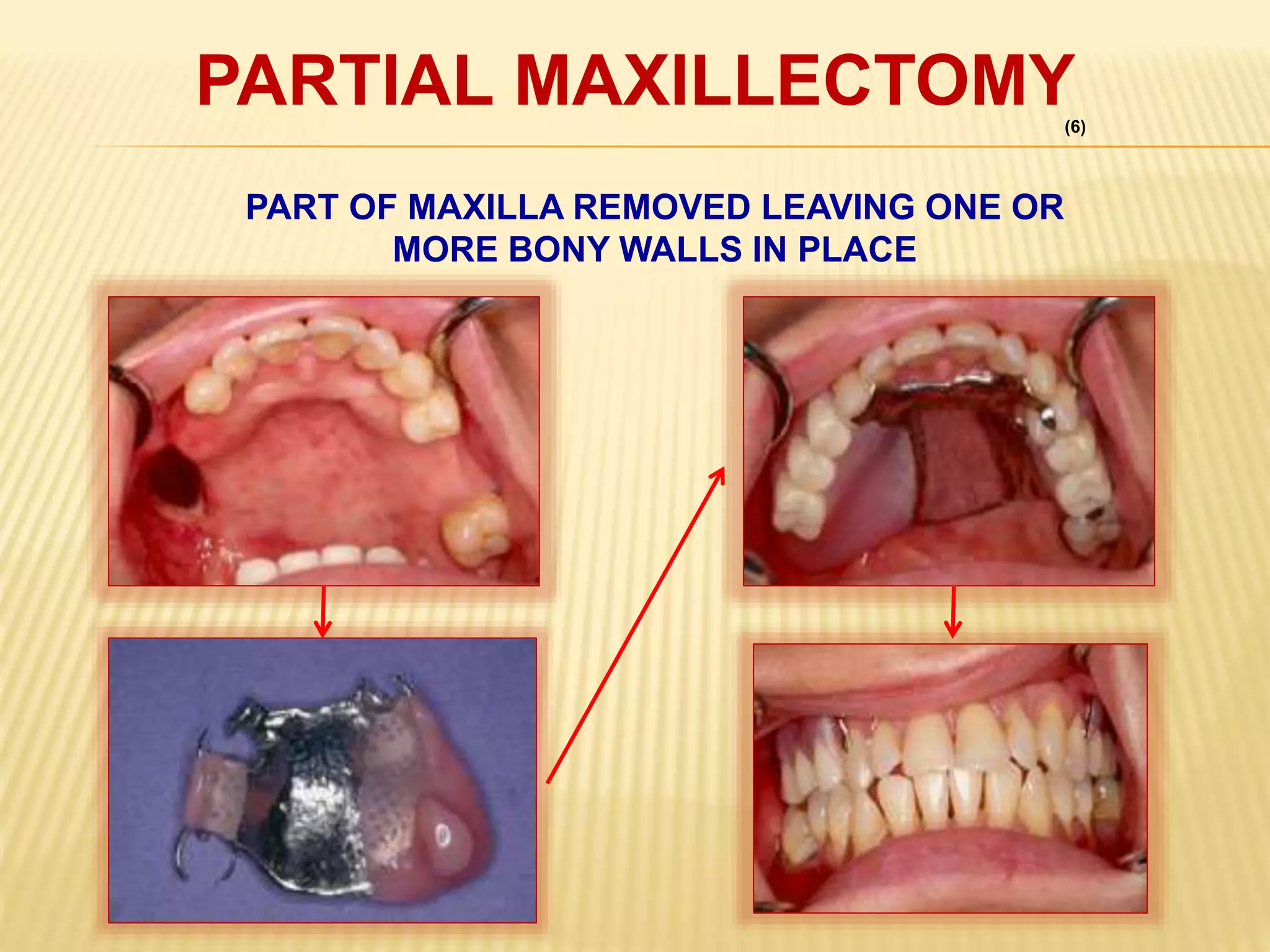 PARTIAL MAXILLECTOMY
PART OF MAXILLA REMOVED LEAVING ONE OR
MORE BONY WALLS IN PLACE
(6)
 