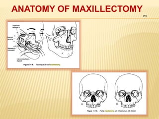 (14)
ANATOMY OF MAXILLECTOMY
 