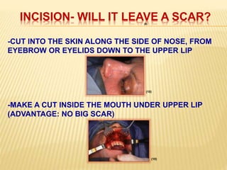 INCISION- WILL IT LEAVE A SCAR?
-CUT INTO THE SKIN ALONG THE SIDE OF NOSE, FROM
EYEBROW OR EYELIDS DOWN TO THE UPPER LIP
-MAKE A CUT INSIDE THE MOUTH UNDER UPPER LIP
(ADVANTAGE: NO BIG SCAR)
(9)
(10)
(10)
 