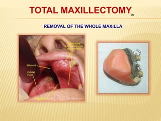 TOTAL MAXILLECTOMY
REMOVAL OF THE WHOLE MAXILLA
(7)
 