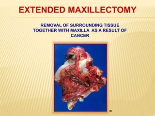 EXTENDED MAXILLECTOMY
REMOVAL OF SURROUNDING TISSUE
TOGETHER WITH MAXILLA AS A RESULT OF
CANCER
(8)
 