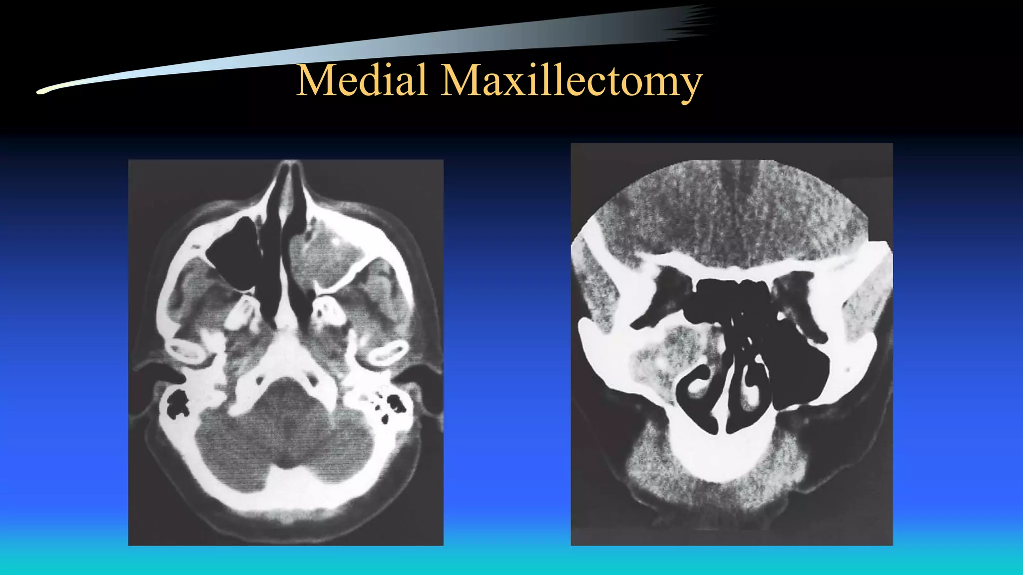 Medial Maxillectomy
 