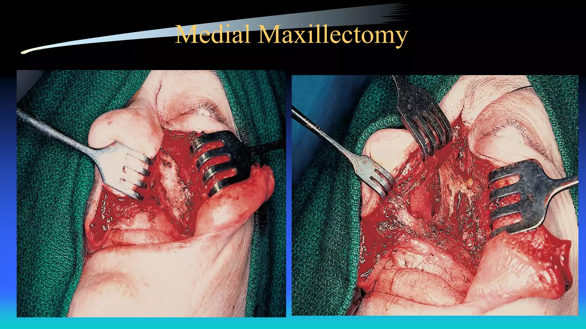 Medial Maxillectomy
 