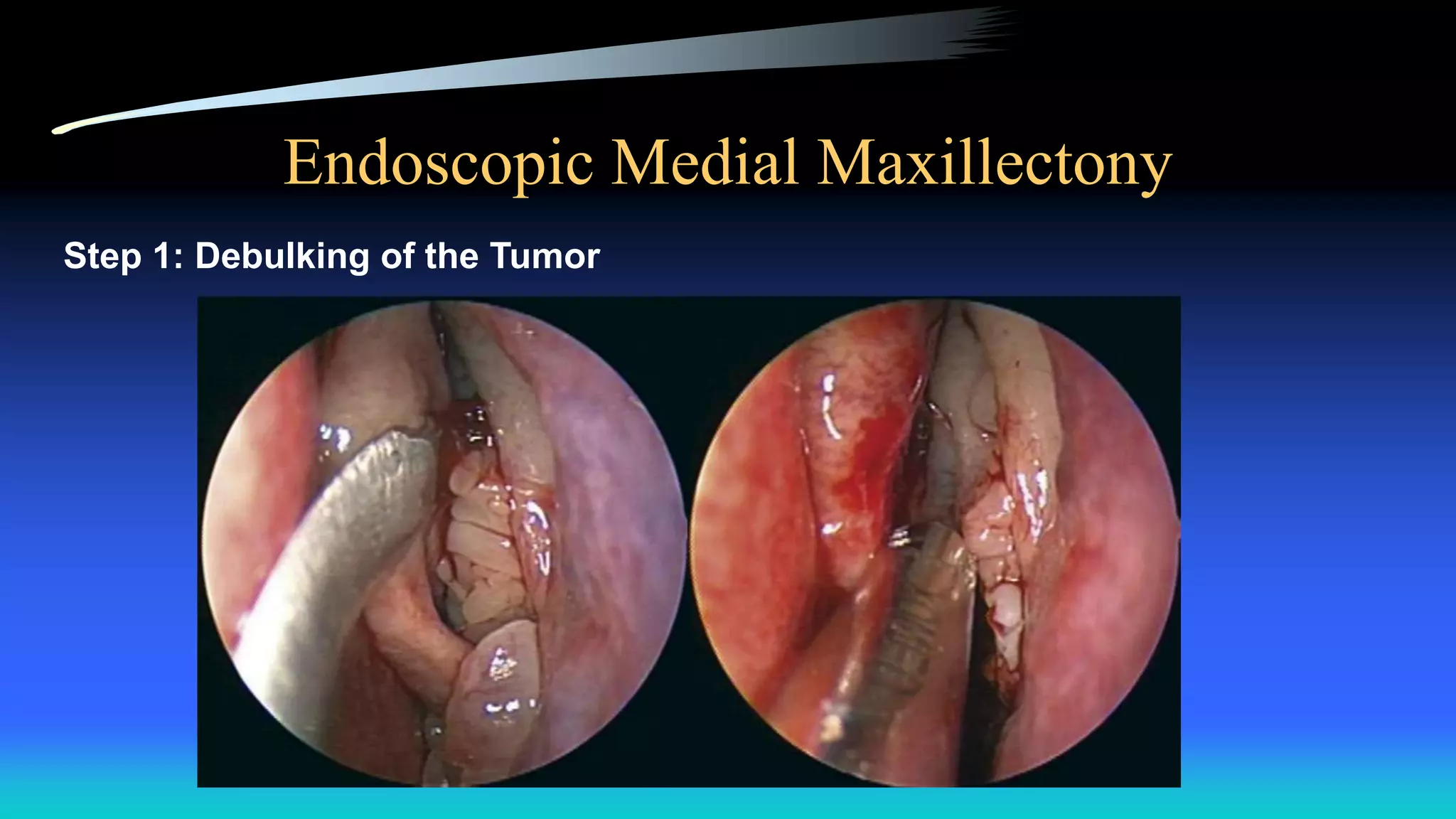 Endoscopic Medial Maxillectony
Step 1: Debulking of the Tumor
 