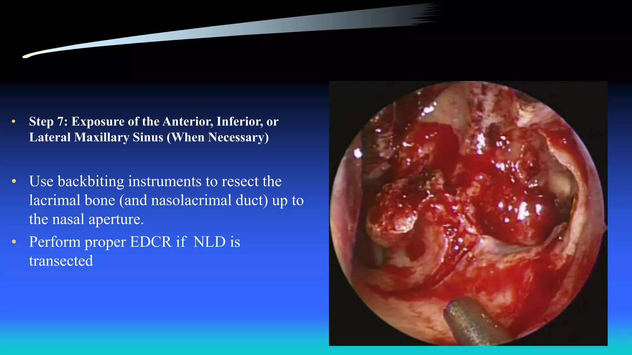 • Step 7: Exposure of the Anterior, Inferior, or
Lateral Maxillary Sinus (When Necessary)
• Use backbiting instruments to resect the
lacrimal bone (and nasolacrimal duct) up to
the nasal aperture.
• Perform proper EDCR if NLD is
transected
 