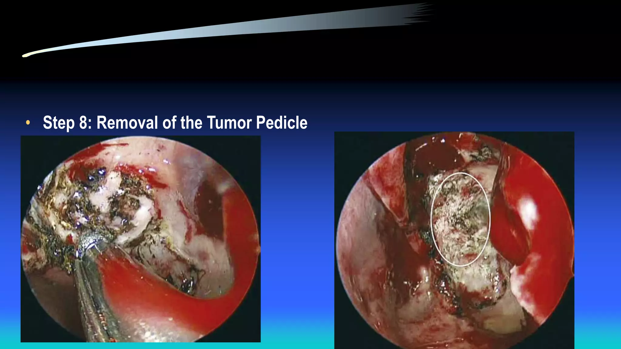 • Step 8: Removal of the Tumor Pedicle
 