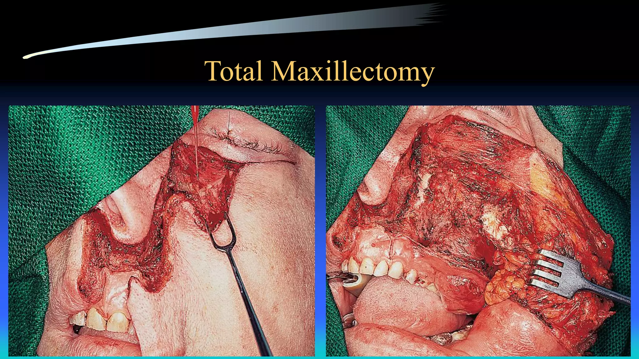 Total Maxillectomy
 