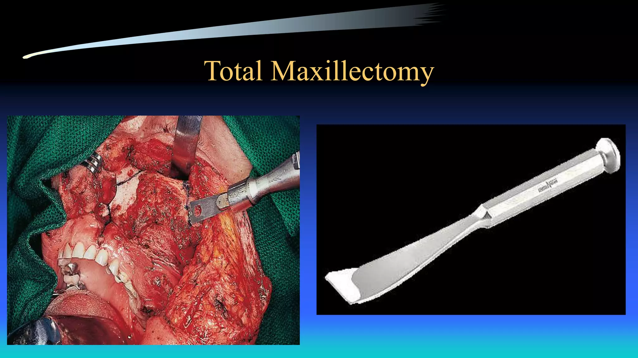 Total Maxillectomy
 