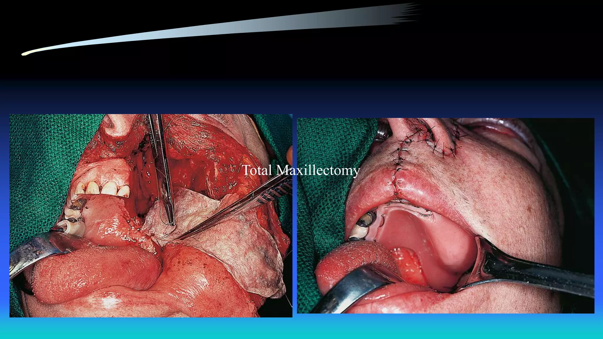 Total Maxillectomy
 