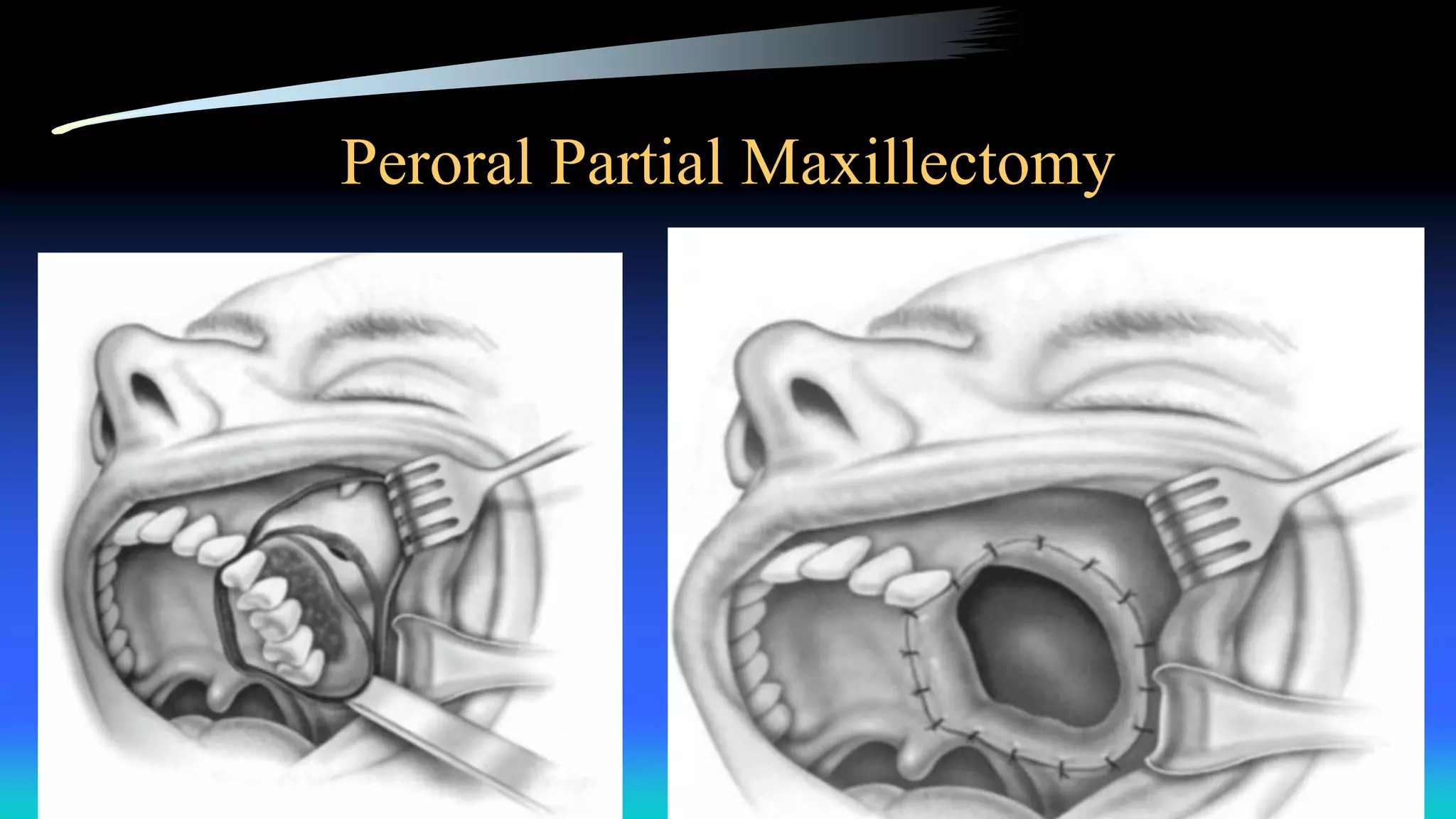 Peroral Partial Maxillectomy
 