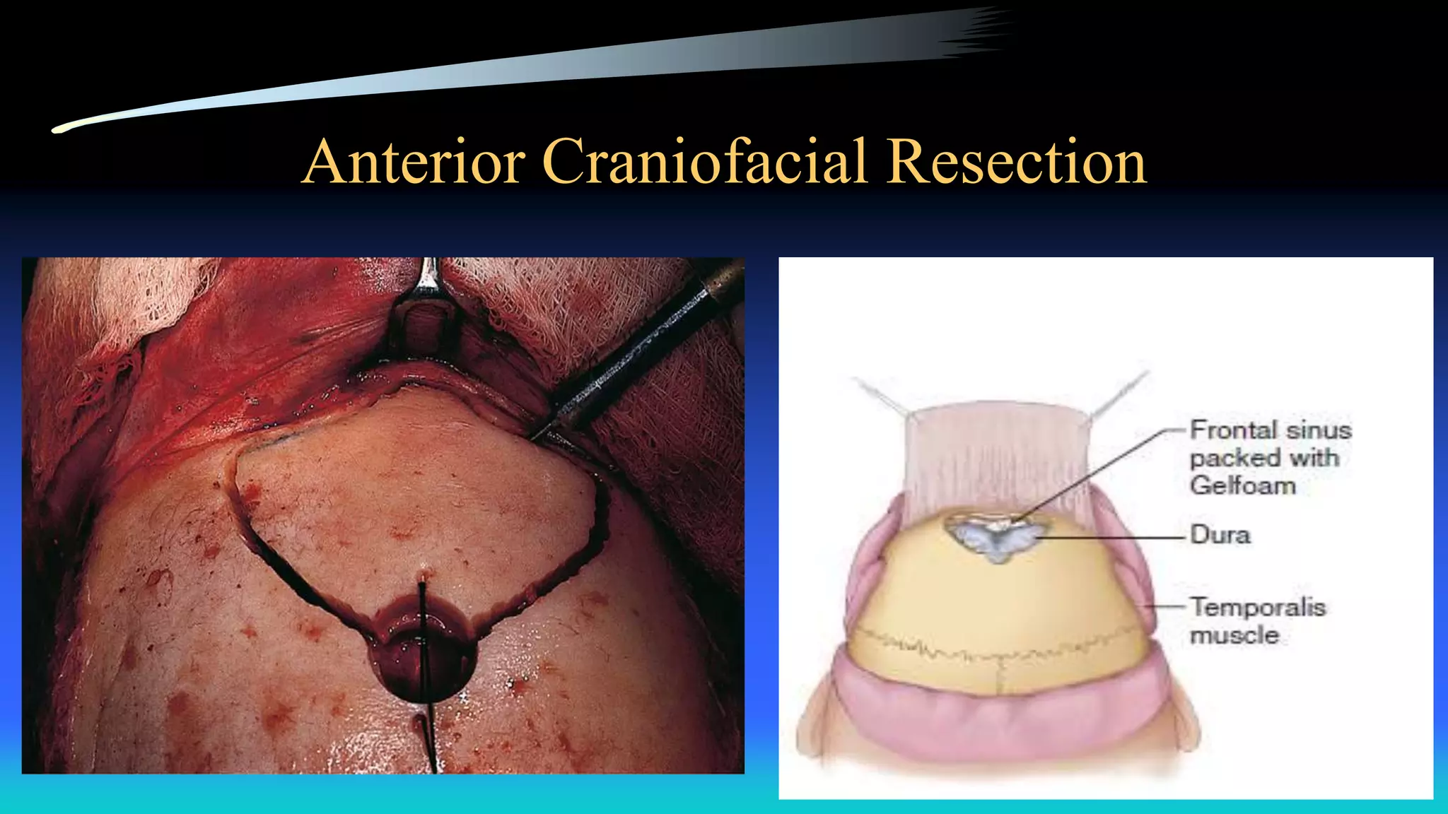 Anterior Craniofacial Resection
 
