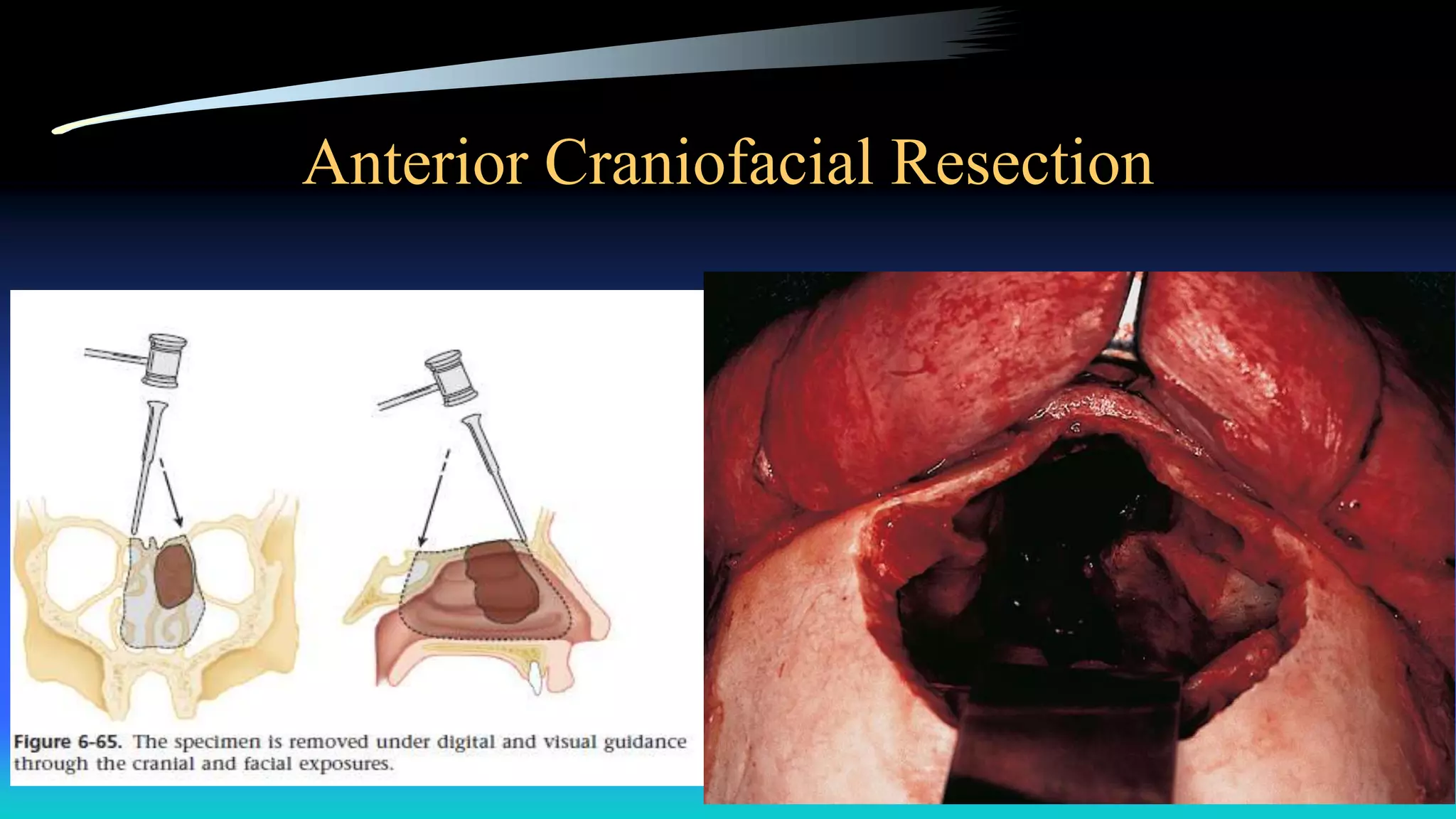 Anterior Craniofacial Resection
 