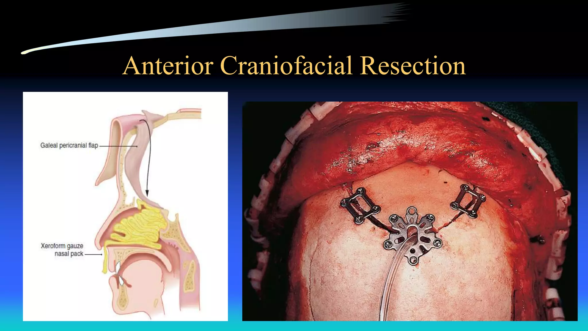 Anterior Craniofacial Resection
 