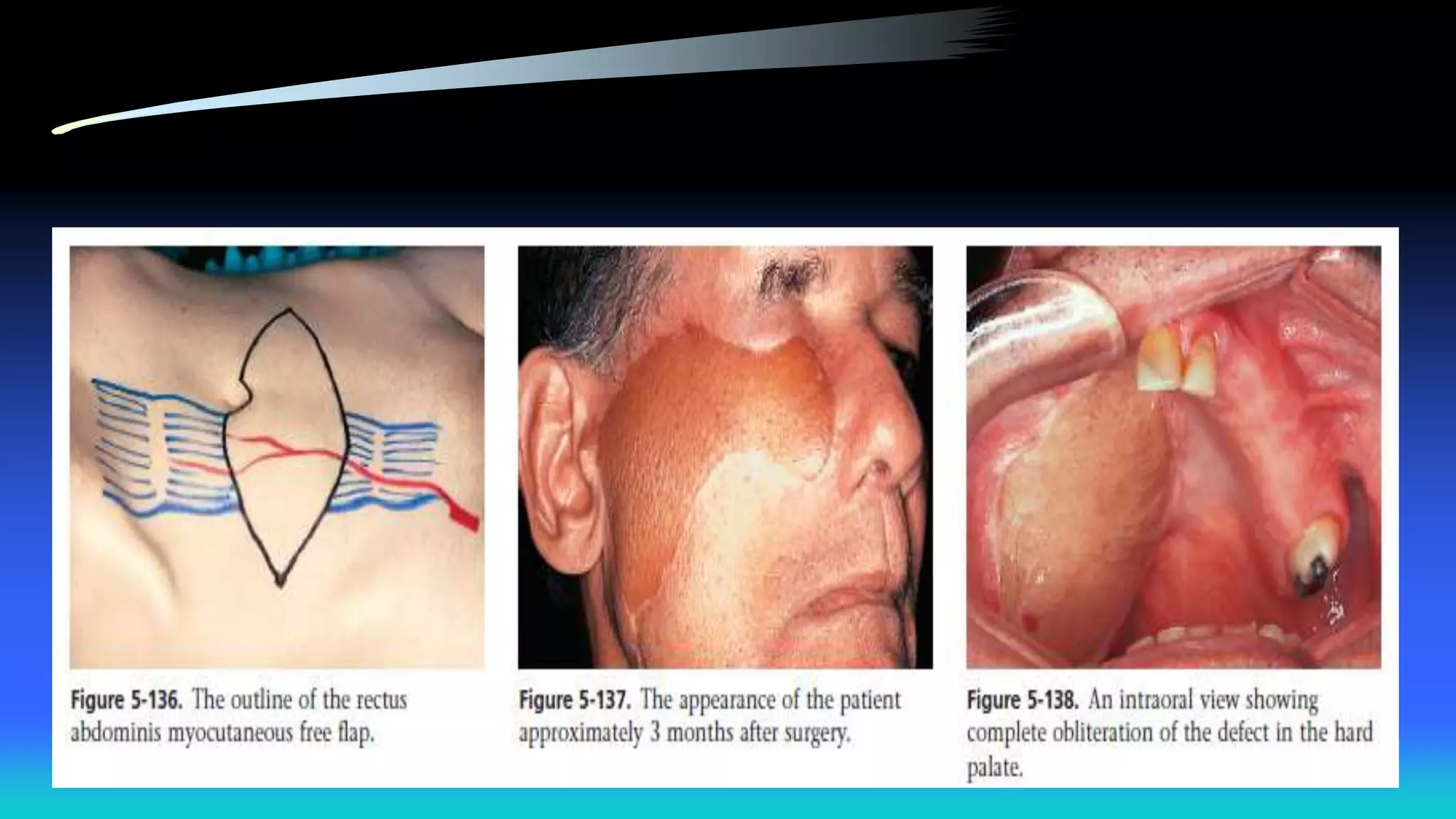 Maxillectomy and craniofacial resection 