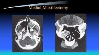 Medial Maxillectomy
 