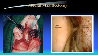 Medial Maxillectomy
 