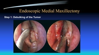Endoscopic Medial Maxillectony
Step 1: Debulking of the Tumor
 