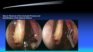 Step 2: Removal of the Uncinate Process and
Identification of the Natural Ostium
 