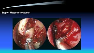 Step 6: Mega-antrostomy
 