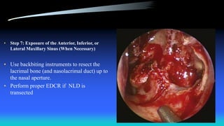 • Step 7: Exposure of the Anterior, Inferior, or
Lateral Maxillary Sinus (When Necessary)
• Use backbiting instruments to resect the
lacrimal bone (and nasolacrimal duct) up to
the nasal aperture.
• Perform proper EDCR if NLD is
transected
 