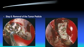 • Step 8: Removal of the Tumor Pedicle
 
