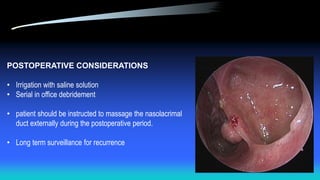 POSTOPERATIVE CONSIDERATIONS
• Irrigation with saline solution
• Serial in office debridement
• patient should be instructed to massage the nasolacrimal
duct externally during the postoperative period.
• Long term surveillance for recurrence
 