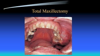Total Maxillectomy
 