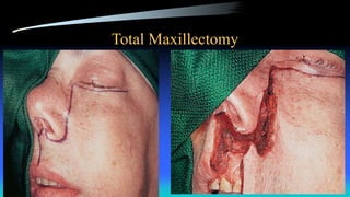 Total Maxillectomy
 