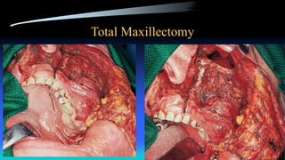 Total Maxillectomy
 