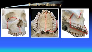 Total Maxillectomy
 